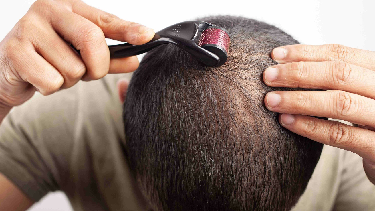 Hair Transplant Image 12