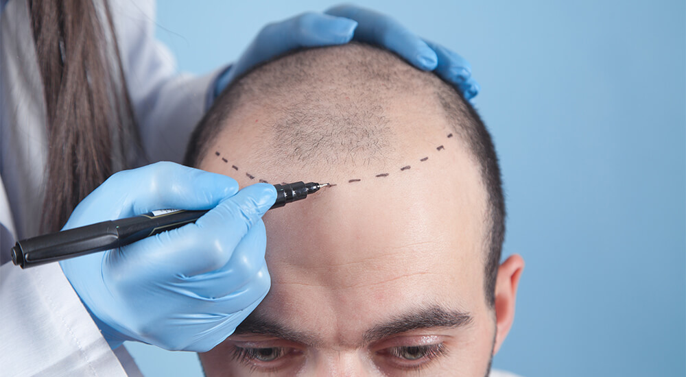 Hair Transplant Image 19