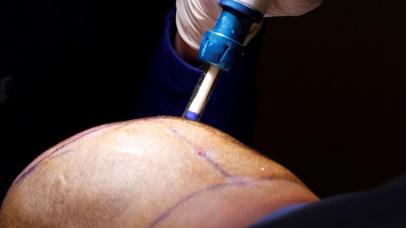 Hair Transplant Image 17