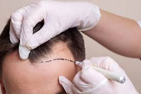 Hair Transplant Image 15