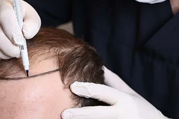 Hairline-Determination-Using-Laser