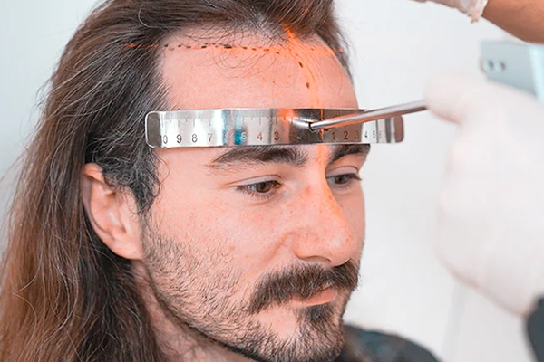 Long-Hair-FUE-Hair-Transplantation