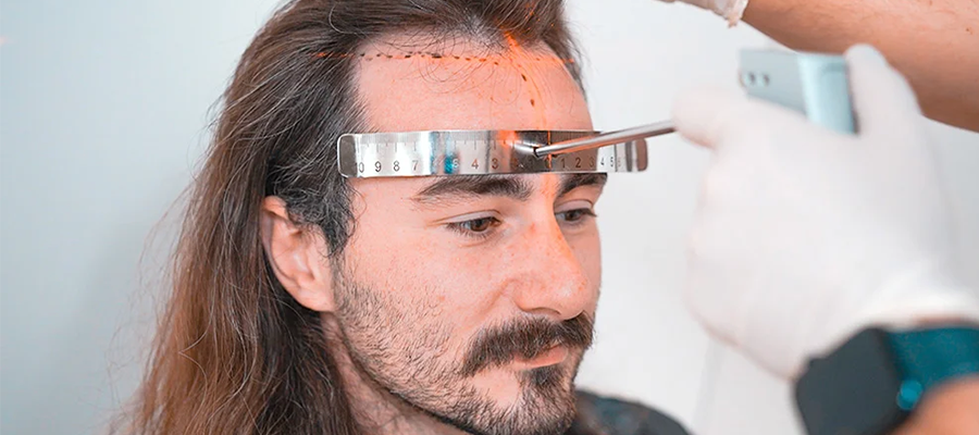 Long-Hair-FUE-Hair-Transplantation