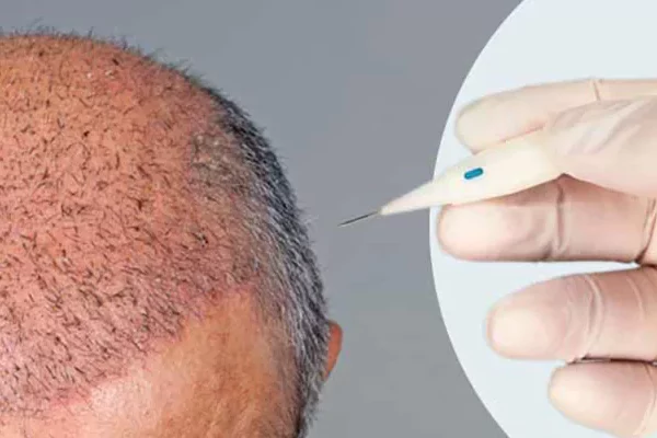 dhi-hair-transplantation