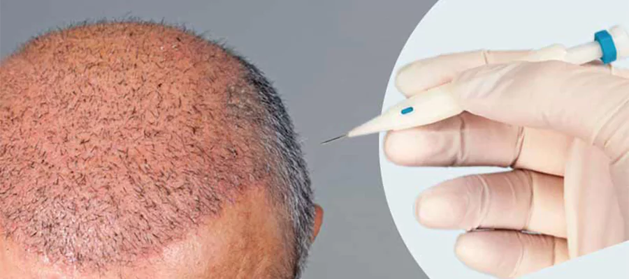 dhi-hair-transplantation