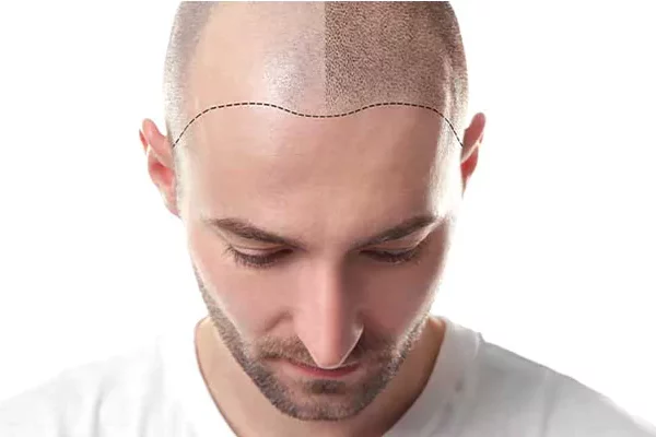 fue-hair-transplantation