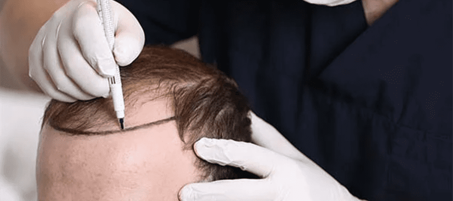 Hairline-Determination-Using-Laser