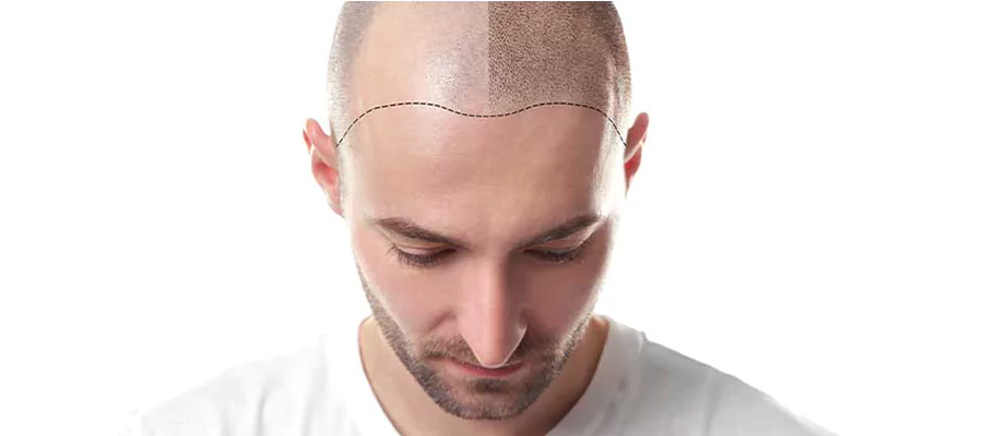 fue-hair-transplantation