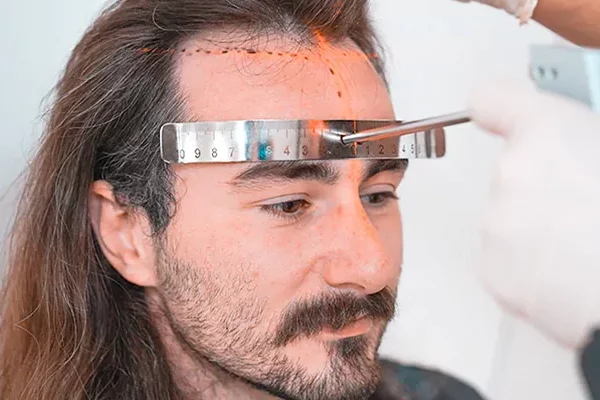 long-hair-fue-hair-transplantation