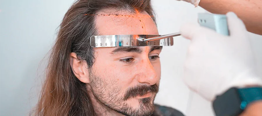 long-hair-fue-hair-transplantation