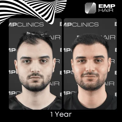 hair transplant in Turkey before after