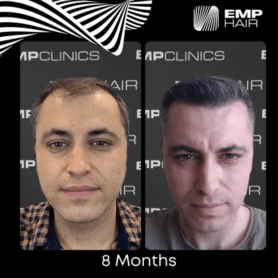 hair transplant in Turkey before after