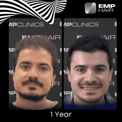 hair transplant in Turkey before after