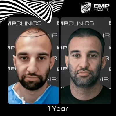 hair transplant in Turkey before after