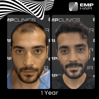 hair transplant in Turkey before after