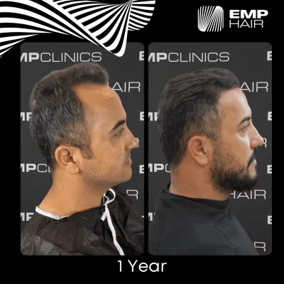 hair transplant in Turkey before after